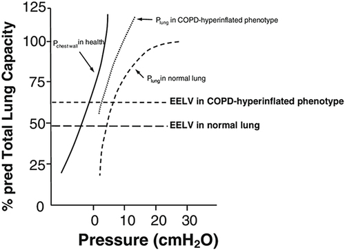 Figure 1 Change in end-expiratory lung volume (EELV) with COPD. EELV is set at the point at which the elastic recoil pressures of the lung and chest wall are equal and opposite in direction. In COPD patients with hyperinflation, emphysema decreases lung elastic recoil pressure and causes a reset of functional residual capacity, or EELV, at a higher absolute lung volume. The difference between expected (long-dashed horizontal lines) and observed EELV (short-dashed horizontal lines) represent static hyperinflation. Reprinted from Dubé B, Guerder, (A), Morelot-Panzini, (C) et al. The clinical relevance of the emphysema-hyperinflated phenotype in COPD. COPD Research and Practice. 2015;2(1). This source is Open Access, the figure was copied under the terms of the Creative Commons Attribution 4.0 International License (http://creativecommons.org/licenses/by/4.0/).Citation16
