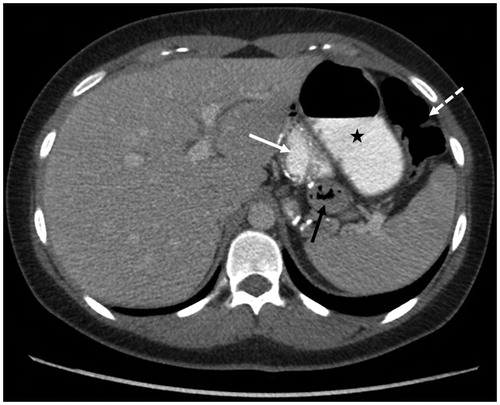 Figure 1. Axial CT image of the upper abdomen after IV contrast administration and oral contrast intake. A blind-ending air and contrast containing intestinal loop (star) can be seen in between the descending colon (dotted arrow), the stomach pouch (white arrow) and the excluded part of the stomach (black arrow).