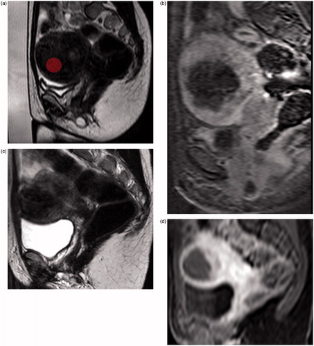 Figure 2. About 122 cc uterine fibroid with high mean sum of entropy (1.82) corresponding to an ablation efficiency of 1.9. The “in-MRI room” duration was 113 min: (a) sagittal T2-weighted image with ROI on MAZDA; (b) sagittal T1-weighted contrasted enhanced imaging showing a non-perfused volume of 54 cc (44%); (c) sagittal T2-weighted image 1 year after MRgFUS; (d) sagittal T1-weighted contrasted enhanced imaging 1 year after MRgFUS showing a significant volume decrease.