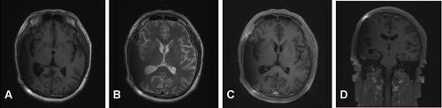 Figure 5 Three-month follow-up (MRI). T1-weighted and T2-weighted images show the midline structure returned to normal. A mild edema of temporoparietal was observed (A and B). Contrast-enhanced T1-weighted images (C and D) show no sign of recurrence.