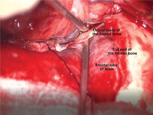 Figure 6 Intraoperative image.