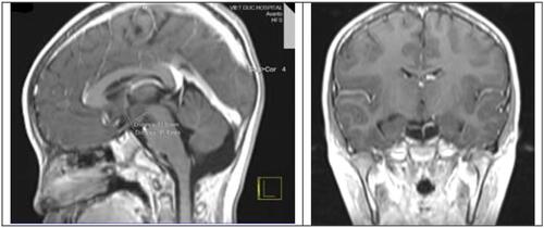 Figure 1 Brain MRI 1.5 Tesla (in hypothalamus area, mainly on coronal and sagittal sequences) revealed a hypothalamus lesion measuring 12*14*8 mm located on the right of the third ventricle, attached to mammillary nuclear and between tuber cinereum and optic chiasma.