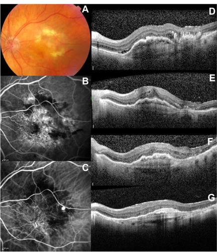 Figure 1 Selected case: A 76-year-old man was referred for decreased visual acuity in the left eye. Baseline examination, including (A) fundoscopy, (B) fluorescein angiography, (C) ICG angiography, and (D) macular OCT revealed a vascular PED associated with exudative AMD. The baseline BCVA and PED height were 20/80 and 380 μm, respectively. The same eye (E) at 3 months (BCVA: 20/70; PED height: 236 μm), (F) at 6 months (BCVA: 20/70; PED height: 176 μm), and (G) at 12 months (BCVA: 20/60; PED height: 166 μm), after the first ranibizumab injection.
