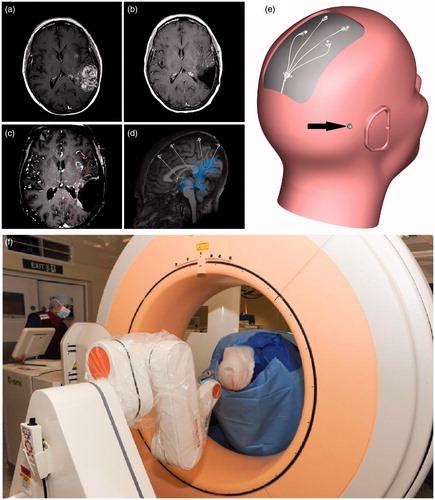 Figure 1. Progression of both the left parietal and left insular tumor masses occurred following treatment with PCV (a). A macroscopic resection of the parietal lesion was undertaken prior to catheter implantation (b). In the four-week interval between resective surgery and catheter implantation, significant tumor progression occurred with new enhancement around the resection cavity as well as progression of the insular lesion (c). Using an in-house modification to neuro | inspire™ stereotactic planning software, the volume of tumor enhancement was delineated (shown in outline) and four catheter trajectories were planned (d) as well as the site for implantation of the TBAP (e; black arrow). Targeting accuracy was determined by performing intra-operative O-arm imaging (f).