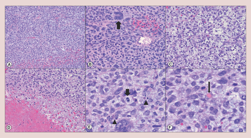 Figure 2. Pathologic findings of undifferentiated embryonal sarcoma of the liver.Undifferentiated embryonal sarcoma of the liver generally shows (A) hypercellular sheets of tumor cells (hematoxylin & eosin, 4×); (B) the neoplastic cells are highly pleomorphic with an increased nuclear to cytoplasmic ratio and hyperchromatic nuclei; tumor giant cells (thick arrow) are frequently identified (hematoxylin & eosin, 10×). (C) The lesional cells are focally elongated/spindled with a loose, myxoid stroma (hematoxylin & eosin, 10×). (D) Necrosis (lower left) is occasionally seen (hematoxylin & eosin, 10×). (E) Mitotic figures (thick arrow) and apoptotic bodies (arrowheads) are readily identified (hematoxylin & eosin, 20×). (F) Eosinophilic hyaline globules (thin arrow), which are PAS-positive and diastase-resistant, may be observed in the neoplastic cell cytoplasm and extracellular matrix (hematoxylin & eosin, 20×).