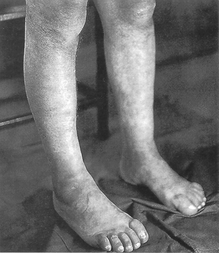 Figure 1 Typical appearance of lower extremities in the older of the two brothers (case 1) with Strumpell's disease.