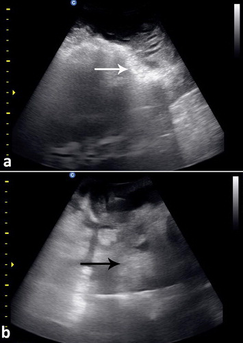 Figure 23. Intraoperative ultrasonographic view of the gastric mass showing the abomasal wall appeared thickened, vascularized, hyperechoic (white arrow, a) and the contents appeared heterogeneous (black arrow, b).