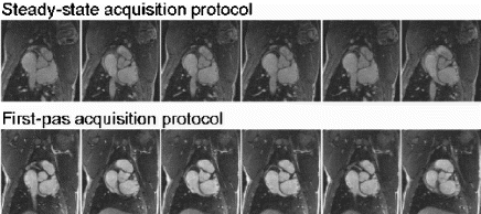 Figure 2. Acquired images for the applied acquisition protocols to illustrate the study results. Upper row: steady-state acquisition protocol; 5 out of a stack of 20 slices. The acquisition was started 1 minute following bolus injection. Lower row; first-pass acquisition protocol; 5 out of 20 slices. The acquisition was started 8.5 seconds following bolus administration. Note the improved contrast of the coronary artery and the perivascular tissues of the images acquired during first-pass.