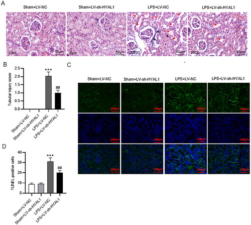 Figure 2. HYAL1 depletion alleviated renal injury of LPS-induced AKI mice. (A) HE staining for renal histological changes in Sham + LV-NC, Sham + LV-sh-HYAL1, LPS + LV-NC and LPS + LV-sh-HYAL1 groups (scale bar = 50 μm). 200×. Black arrow presents inflammatory cellular infiltration in the renal interstitium. Red arrow presents severe granular in renal tubular epithelial cells, vacuolar degeneration, and renal tubular necrosis. (B) Tubular injury scores in Sham + LV-NC, Sham + LV-sh-HYAL1, LPS + LV-NC and LPS + LV-sh-HYAL1 groups. (C, D) TUNEL assay for apoptotic cells in renal tissues of mice in Sham + LV-NC, Sham + LV-sh-HYAL1, LPS + LV-NC and LPS + LV-sh-HYAL1 groups (scale bar = 100 μm). N = 10 mice each group. ***p < .001 vs. Sham + LV-NC group; ##p < .01 vs. LPS + LV-NC group.
