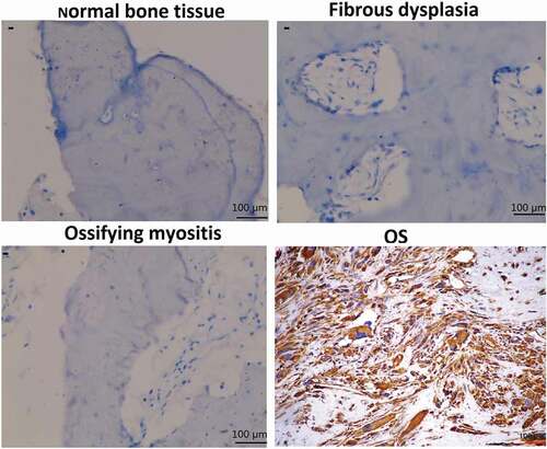 Figure 1. sCLU immunoreactivity in normal bone, fibrous dysplasia, ossifying myositis, and OS tissues. The ‘−’ and ‘+’ symbols in the cytoplasm of cells indicate negative and positive staining, respectively (200× magnification).