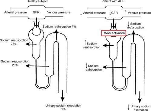 Figure 1 Schematic representation of the cascade of events leading to impaired urinary sodium excretion in AHF.