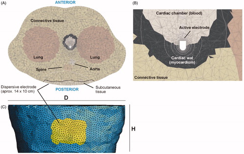 Figure 5. Details of the meshing used in the full thorax model. (A) Cross section at the level of the active electrode. Dotted line represents approximately the contour of the subcutaneous tissue. (B) Close-up of the zone around the active electrode. (C) Posterior view showing the meshing and position of the elements (yellow) on which an electrical condition of zero voltage was set, mimicking the location of the dispersive electrode.