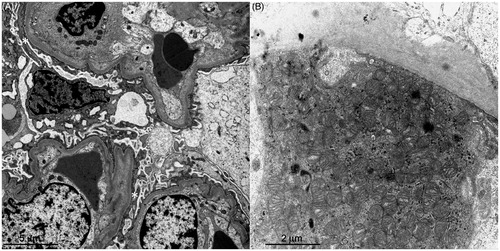 Figure 2. The electron microscopic findings. (A) The foot processes of podocytes are effaced (asterisks). (B) The granular swollen epithelial cells have increased numbers of mitochondria, a portion of which are enlarged, and some of which have cristae that have lost their normal structure.