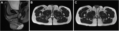 Figure 1 Preoperative MRI scan of the penis and pelvic floor. Sagittal (A) and axial (B and C) images showed severe hypoplasia of the corpus spongiosum and distal deficiency of both corpora cavernosa. The prostate gland was small and almost difficult to identify. These findings were compatible with the diagnosis of the fusiform variety of congenital megalourethra.