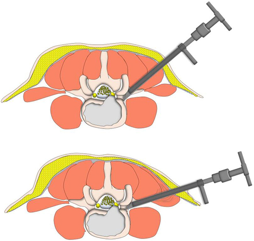 Figure 4 Schematic diagram of “press-down enlargement of foramen” in PTES. The 8.8-mm protective cannula was docked at the facet joint and pressed down further to make the angle of cannula to horizontal plane smaller, and a 7.5-mm trephine was introduced to cut the ventral bone of articular process for the enlargement of intervertebral foramen, which made the working channel easily inserted into the spinal canal even if the puncture angle was 85° to the horizontal plan.