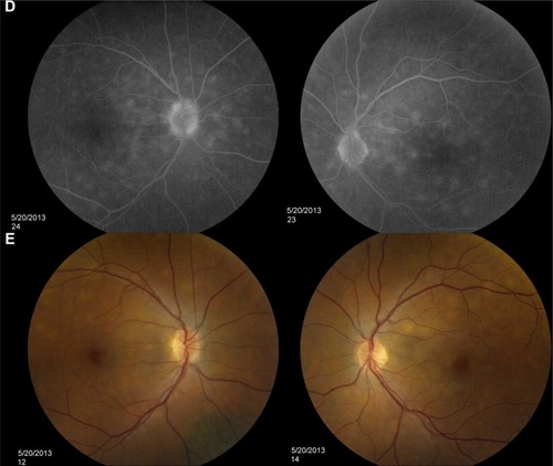 Figure 4 Fundus photos and FA studies of Case 2.