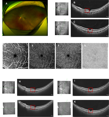 Figure 2 Fundus images of the left eye in case 2. Fundus photography (A) was normal. OCT disclosed hyper-reflective segment of OPL and ONL, and associated disruption of ellipsoid, interdigitation zones, and RPE layers on the nasal ((B), red box) and upper macular ((C), red box). No flow defects in the superficial (D)/intermediate (E)/deep (F) retinal capillary plexuses and choroidal capillary plexus (G) on OCTA. Three weeks after oral prednisone administration, hyper-reflectivity of the OPL and ONL completely faded with definable ellipsoid, interdigitation zones, and RPE layers both on the nasal ((H), red box) and upper ((I), red box) macular on OCT. Six weeks later only slight irregularity of ellipsoid, interdigitation zones, and RPE layers persisted on OCT, on the nasal ((J), red box) and upper ((K), red box) macular areas.
