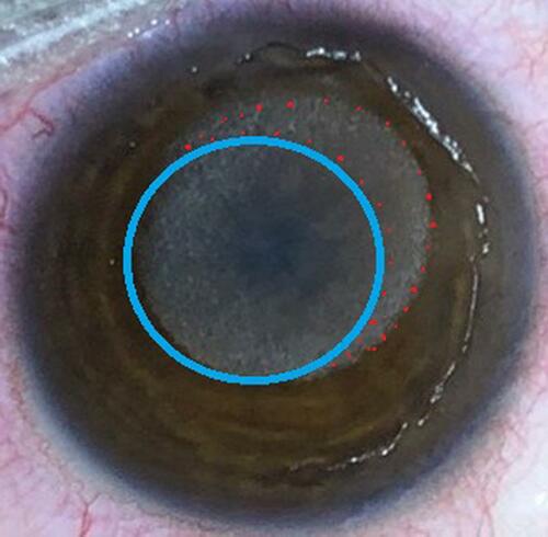 Figure 5 Ablation pattern of case 1: Purple circled round area indicates ablation pattern (total =5.50 diopters) of both refractive error (−4.0 diopters) and myopic shift (−1.50 diopters) due to LAK-SCAP, and red dotted circled area indicates LAK-SCAP on the thicker area of the cornea.