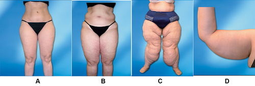 Figure 1 Lipedema staging. (A) Stage 1 - skin appears smooth, but the thickened subcutaneous tissue contains small nodules. (B) Stage 2 - skin has an irregular texture, subcutaneous nodules occur that vary from the size of walnut to that of an apple in size. (C) Stage 3 - deformed lobular fat deposits form, especially around thighs and knees, and may cause considerable distortion of limb profile. (D) Stage 4 - lipedema with lymphoedema (lipolymphoedema).