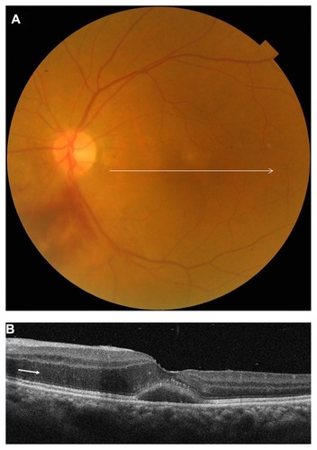 Figure 3 A 74-year-old woman (patient 7) with a branch retinal vein occlusion had a 2-week history of blurred vision in her left eye. Best-corrected visual acuity was 0.9. (A) Fundus photograph shows serous macular detachment and a part of the flame-shaped hemorrhages extending from the optic disk to the inferonasal midperipheral fundus. The horizontal arrow indicates optical coherence tomography scanning lines (6 mm). (B) A horizontal optical coherence tomography scan shows a serous retinal detachment at the fovea and outer retinal swelling, which is evident nasal to the fovea (arrow).