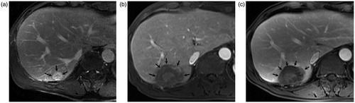 Figure 1. A 63-year-old male patient undergoing percutaneous microwave ablation for primary intrahepatic cholangiocarcinoma (a). Enhanced MR images show a 2.1 cm lesion with heterogeneous enhancement (arrows) located in right posterior lobe before microwave ablation; Enhanced MR images four months (b) and 13 months (c) after ablation show a non-enhanced area with a clear margin in corresponding site (arrows), and no new lesion was detected.