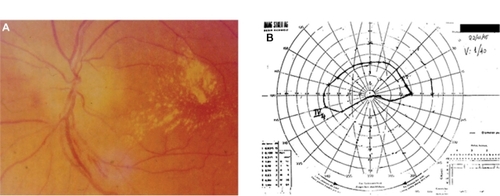 Figure 1 Patient 1 (Tables 2 and 3) with neuroretinitis: optic disc edema and macular star (A) and AION (B) with characteristic visual fields defect and positive serology for Bartonella henselae and history of cat scratch.