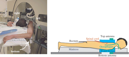 Figure 1. Patient set up in the 70 MHz AMC-4 phased array locoregional hyperthermia system during treatment (left) and a schematic representation of the applied thermometry (right).