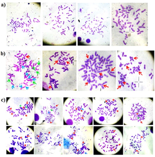 Figure 2. The representative picture of the metaphases obtained from the stress cytogenetics culture; (a) metaphase cells from the negative control cases, where virtually no break or radial structure was found, (b) metaphase cell from the positive control cases, where very high number of break, radial, bi-radial, and tri-radial structures are observed, (c) metaphases from the six stress cytogenetics positive patients, having a high number of break, radial, bi-radial, and tri-radial structures like positive controls. The picture of the metaphases found from other 57 AA cases who are not positive for stress cytogenetics was like negative controls. MMC acts as a potent DNA cross-linker. Chromosome breakage and radial formation are nothing but Interstrand cross-links (ICLs). ICLs can arise in the pre and post state of DNA replication between homologous regions of sister chromatid. In case of post-replication state ICLs, there is two ways, either homologous repair between sister chromatids produce an error-free repair or mitosis proceeds normally and one of the daughter cells inherits an un-repaired ICL. In case of pre-replication state ICLs, where a homologous sister chromatid is not available for re-combinational repair, the mechanism is completed by three ways, (1) non-homologous end joining, (2) excision repair and/or lesion bypass and (3) homologous repairs between homologous chromosomes. Whereas first two mechanisms are error-prone, the third one is error-free. A mandatory-break is generated by un-repaired ICLs during mitosis. The red, green and blue arrows are indicating the radial structures, chromosomal break and gap respectively.