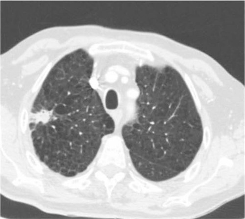 Figure 3 Spiculated nodule in a high-risk patient. ENB results were consistent with aspergilloma. Long-term follow-up has confirmed the benign diagnosis which spared this patient (with limited lung function) a risky surgical resection.