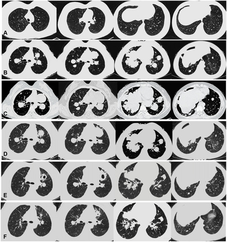 Figure 2 CT of the chest. (A) Local recurrence but without pulmonary metastasis. (B) Multiple pulmonary metastases were found and denosumab initiated. (C) 4 months after denosumab therapy. (D) 3 months after denosumab and apatinib therapy. (E) 15 months after denosumab and apatinib therapy. (F) 33 months after denosumab and apatinib therapy.