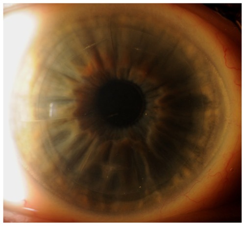 Figure 3 Slit lamp photo of Case 1 right eye, showing clear cornea with DSAEK graft and prior RK incisions.