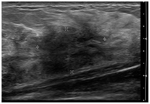 Figure 1 Diabetic mastopathy: ultrasound of a palpable abnormality shows an ill-defined mass-like area with decreased echogenicity and concerning features.