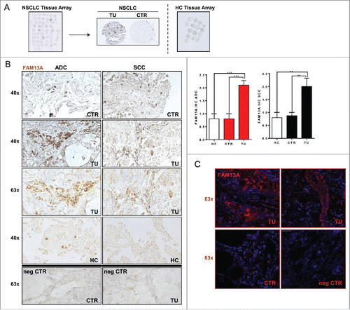 Figure 1. Increased number of cells expressing FAM13A in the tumor region of patients with NSCLC. (A) Histological arrays obtained from the control (CTR) and tumoral region (TU) of lung tissue of our NSCLC patient cohort with adenocarcinoma (ADC) and squamous cell carcinoma (SCC) subtypes as well as lung tissue array from control patients (HC). (B) Immunohistochemistry (IHC) of FAM13A on lung tissue array: control (40x CTR) and tumoral (40x, 63x TU) area of patients with ADC or SCC as well as lung tissue from control patients (40x HC). Staining with anti-FAM13A antibody is shown in brown, negative controls (63x neg CTR) of control and tumoral area are depicted in the lower panel. Diagrams show semi-quantitative analysis of the immunohistochemical staining of ADC and SCC lung section samples comparing tumoral and control area of tumor patients and control area of healthy control patients (N (ADCcontrol) = 10; N (ADCtumoral) = 10; N (SCCcontrol) = 9; N (SCCtumoral) = 9; N (HC) = 10). (C) Confocal microscopic images of lung sections after immunofluorescence of the control (63x CTR) and tumoral (63x TU) area taken from the lung of a patient with SCC and the respective negative control (63x neg. CTR). Staining with anti-FAM13A antibody is shown in red and nuclei are counterstained in blue (DAPI). Data are shown as mean values ± s.e.m. using Student's two-tailed t-test *p = 0.05; **p = 0.01, ***p = 0.001.