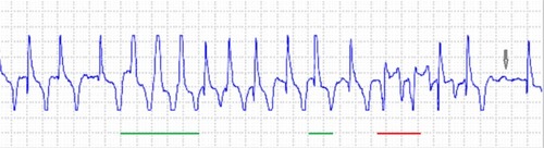Figure 4 Holter electrocardiogram recording from a horse in atrial fibrillation.