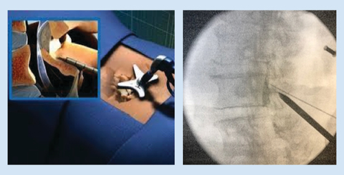 Figure 5. mild portal stabilizer that mitigates ventral migration of the operating devices while allowing for superior and inferior movement to sculpt the interlaminar space.