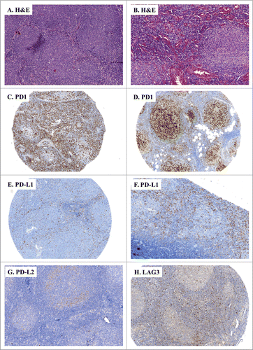 Figure 2. IHC of immune escape markers expressed by FL. (A and B) Classical H&E stainings of FL biopsies (A: FL grades 1–2, ×100, B: FL grade 3, ×100) reveal small and atypical lymphoid cells with a round nucleus and an irregular membrane. (C–H) Representative IHC of FL samples stained for: PD-1 (C: ×100, D: ×200); PD-L1 (E: ×100, F: ×40), PD-L2 (G: ×100), and LAG3 (H: ×100).