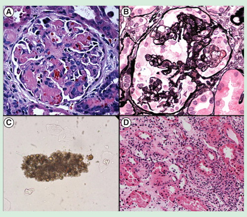 Figure 1. Drug-induced AKI. (A) Glomerulus demonstrating thrombotic microangiopathy from bevacizumab, an anti-VEGF drug. (B) Glomerulus showing collapsing focal segmental glomerulosclerosis from interferon therapy. (C) Urine microscopy demonstrating a methotrexate crystal cast, indicative of crystalline-associated AKI. (D) Acute interstitial nephritis marked by an inflammatory cell infiltrate and edema within the interstitium of the kidney. This lesion occurred from omeprazole exposure.