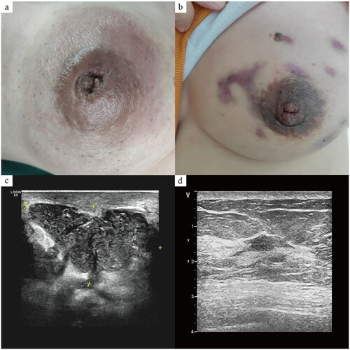 Figure 2. Images of Case 7. (a-b) Breast appearance before and after treatment. Her left breast is erythematous and swollen with nipple retraction (a). There are scars of some pus drainage incisions on the surface, while the appearance is intact (b). (c–d) Ultrasound images before and after treatment. The normal glandular structure had almost disappeared, replaced by diffuse abscess formation (c). basically normal gland structure with a residual small hypoechoic area after treatment (d).