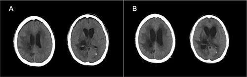 Figure 4 Brain CT on the first day and the 12th day after removal of EVD showing deterioration of hydrocephalus. (A) Brain CT on the first day after removal of EVD showing mild hydrocephalus; (B) brain CT on the 12th day after removal of EVD suggesting aggravation of hydrocephalus.