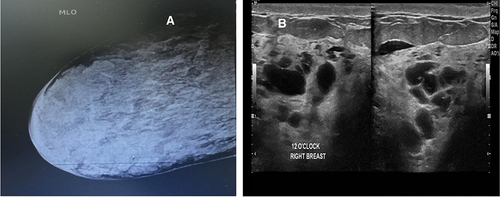 Figure 2 (A) Right mediolateral oblique mammogram. (B) Ultrasound shows multiple cystic lesions preoperatively.