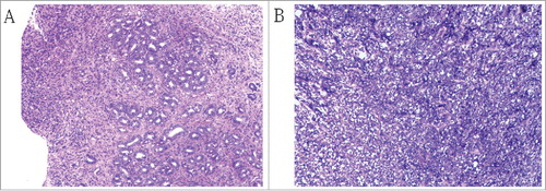 Figure 2. (A) Pre-surgical pathology of biopsy specimen revealing adenocarcinoma of the stomach, Magnification, x100. (B) Post-surgical pathology of the mass revealing a small amount of degenerated nuclear large cells and inflammatory cells infiltration, Magnification, x100.