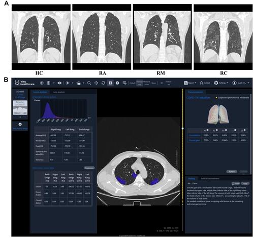 Figure 2 CT images and quantitative analysis with artificial intelligence (AI) system. Vertical scans of four representative patients were illustrated: (A) A 52-year-old male from HCs; A 54-year-old male from Ras; A 52-year-old male from RMs; A 53-year-old male from RCs. (B) COVID-19 pneumonia lesions from a patient in RCs detected by the AI system are displayed with blue pseudo color.