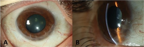 Figure 3 Post-operative slit-lamp photography of anterior segment of the right eye with broad illumination (A) and with slit illumination from side view (B).