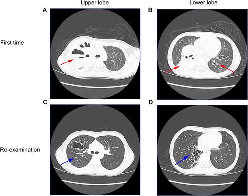 Figure 1 Pulmonary imaging by CT scan before and after treatment.