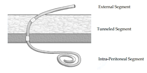 Figure 1. Diagram of Tenckhoff catheter placed in the abdominal cavity for peritoneal dialysis showing placement of the tip in the pelvis and transcutaneous segment. Used with permission from Kidney International (Publisher: Elsevier).