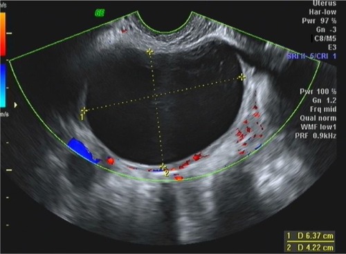 Figure 1 Transvaginal ultrasound in a 25-year-old woman.