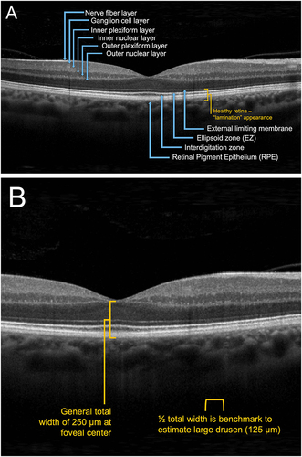 Figure 1 Key landmarks and features in the retina. (A) Healthy retina and retinal layers. (B) Drusen sizing estimation.