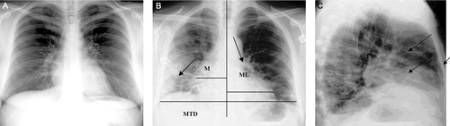 Figure 1.  X-ray films in paint exposure workers. (a) Normal chest radiography. (b) Reticular pattern of both lung fields is noted, as well as an increased cardiothorathic ratio and bilateral increased bronchovascular markings with bilateral hilar congestion. (c) Lateral view showing increased bronchovascular marking with hilar congestion. MTD, Maximum Transverse Diameter of the heart; ML + MR, Maximum Cardiac Diameter.