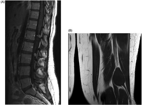 Figure 2. (A) T1-weighted MRI scan with contrast demonstrating the contrast enhanced schwannomas. (B) T1-weighted MRI scan without contrast.