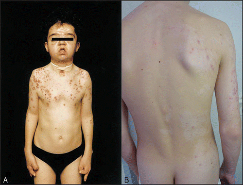 Figure 1 (A) Apert syndrome with early-onset severe nodulocystic acne extending to the forearms and thighs in an 11-year-old boy.Citation28 Two thirds of patients with Apert syndrome exhibit the Ser252Trp FGFR2 mutation, one third of patients the Pro253Arg FGFR2 mutation. (B) Unilateral segmental acneiform nevus in a 15-year old boy with a genetic mosaicism expressing the heterozygous mutation of Ser252Trp of FGFR2 in the affected skin areas following the lines of Blaschko.Citation67 Photographs are kindly provided with permission by the publishers and authors.